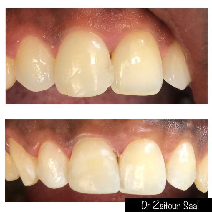 Spatules Dentaires Pour Résine Composite - Instrument De Modelage Chaud - VV Dental